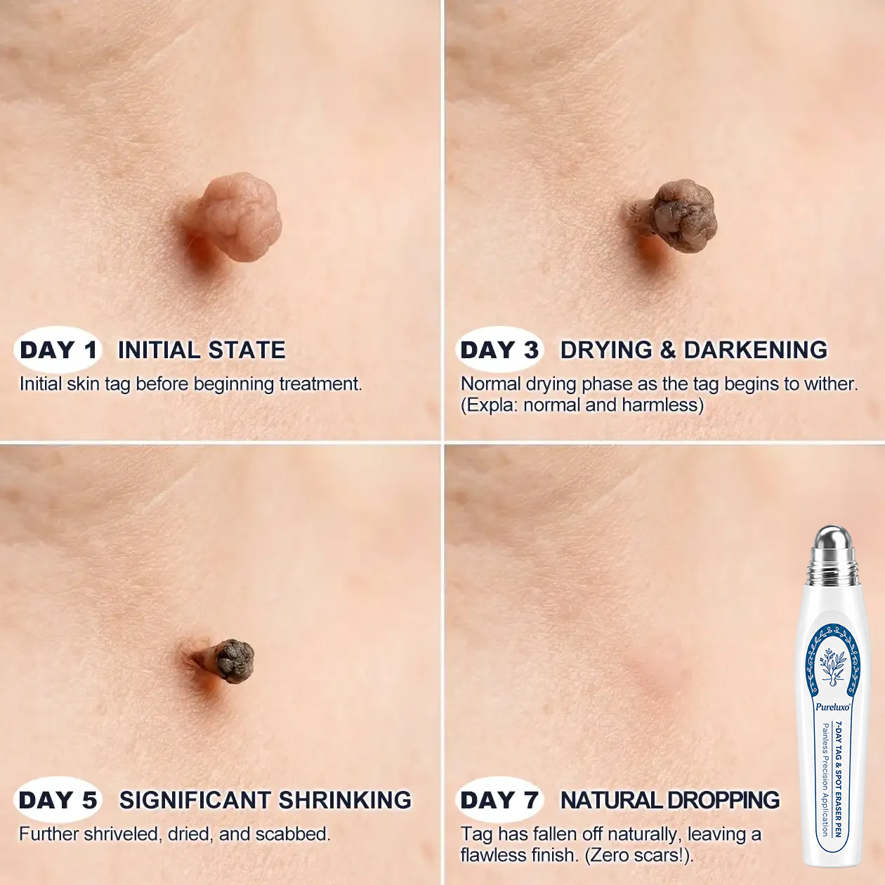Pureluxo® 7-Day Tag & Spot Eraser (Zero Pain, Zero Scars Rollerball)