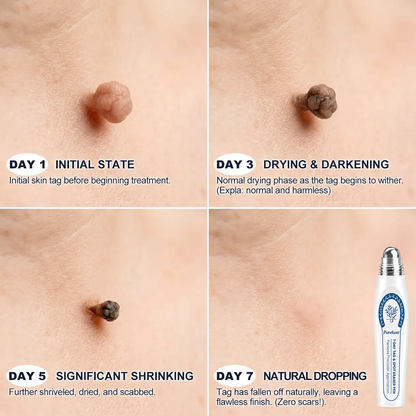 Pureluxo® 7-Day Tag & Spot Eraser (Zero Pain, Zero Scars Rollerball)
