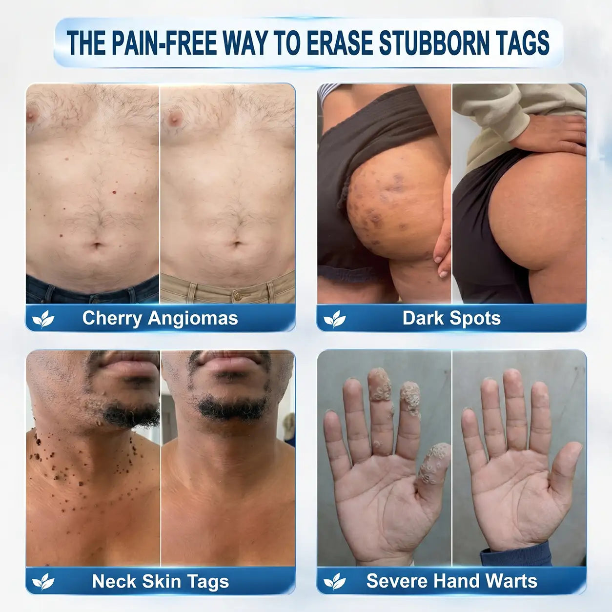 Pureluxo® 7-Day Tag & Spot Eraser (Zero Pain, Zero Scars Rollerball)